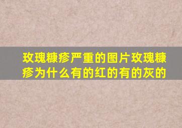 玫瑰糠疹严重的图片玫瑰糠疹为什么有的红的有的灰的